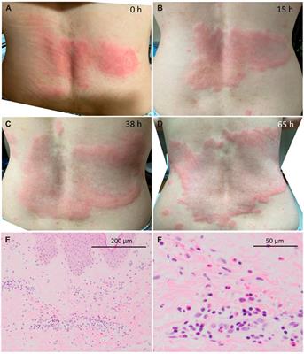 A case of prolonged urticaria associated with lesional eosinophilic infiltrates